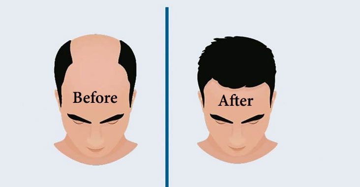 Hair Transplant Cost In India| Factors Influences Hair Transplant Cost