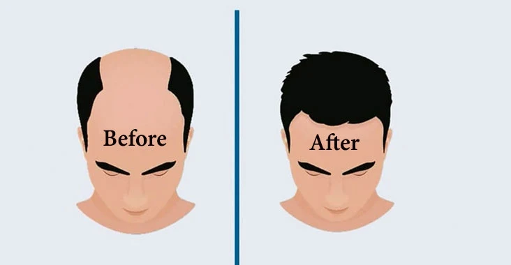 Hair Transplant Cost In India| Factors Influences Hair Transplant Cost