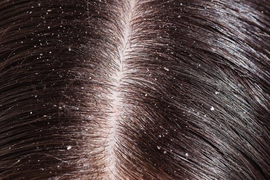 Fascinating Home Remedies To Instantly Get Rid Of Dandruff And Lice