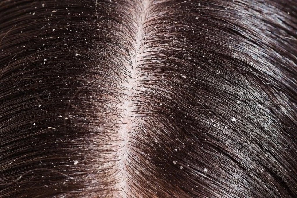 Fascinating Home Remedies To Instantly Get Rid Of Dandruff And Lice