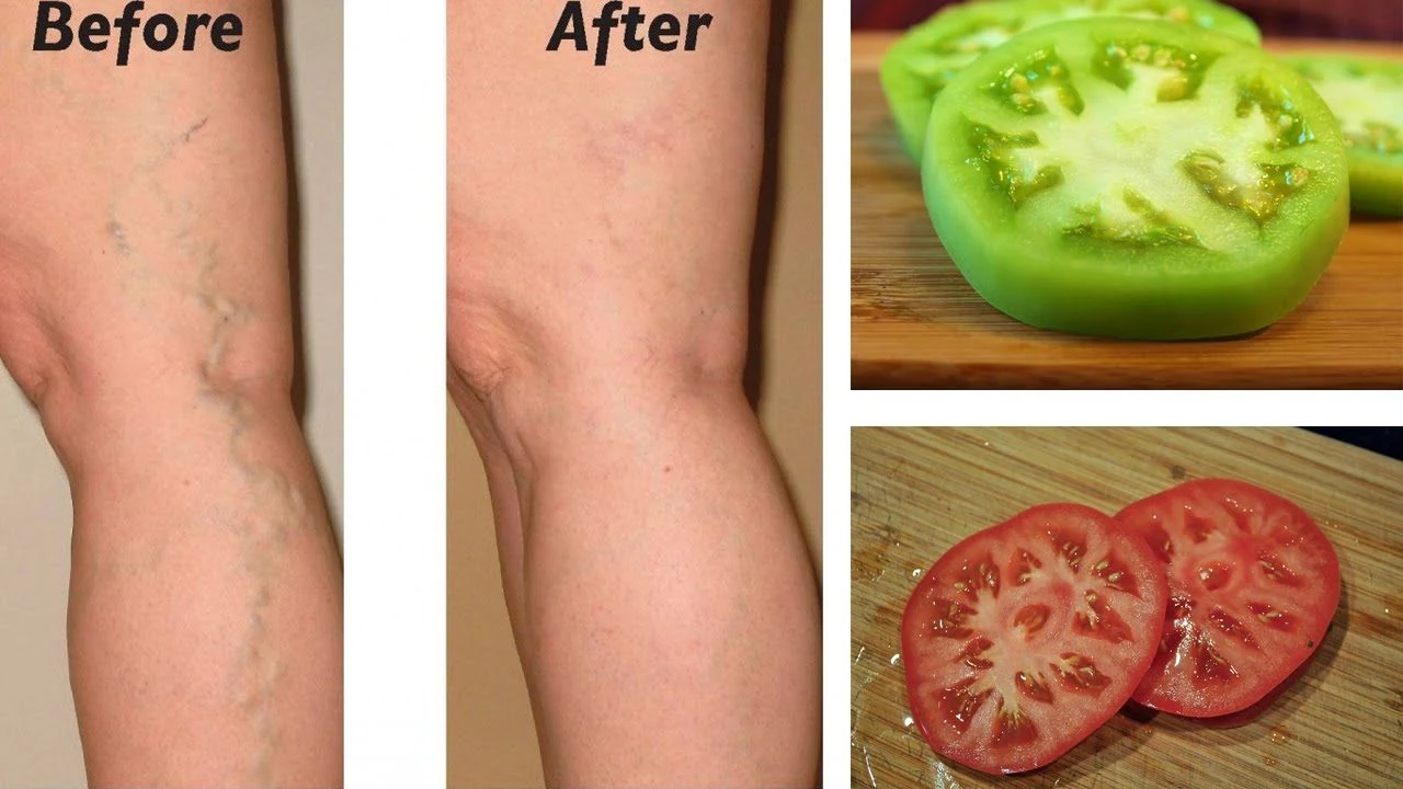 Varicose Veins Natural Treatment At Home
