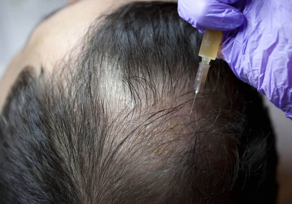 PRP Hair Treatment Cost In India | Process & Side Effects