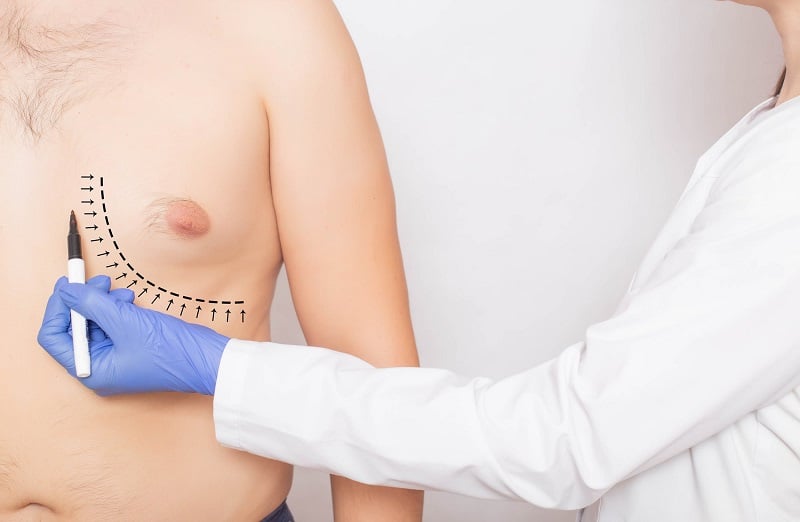 Gynecomastia Surgery Cost In India- Don’t Miss The Opportunity