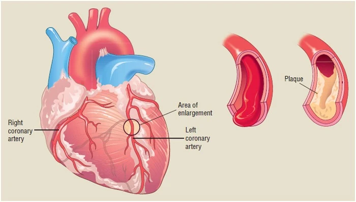 Coronary Heart Disease: Causes, Effect, and Protection