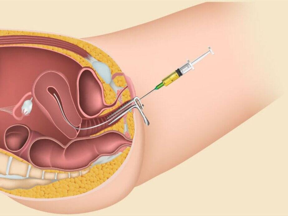 Is IUI Process Painful?