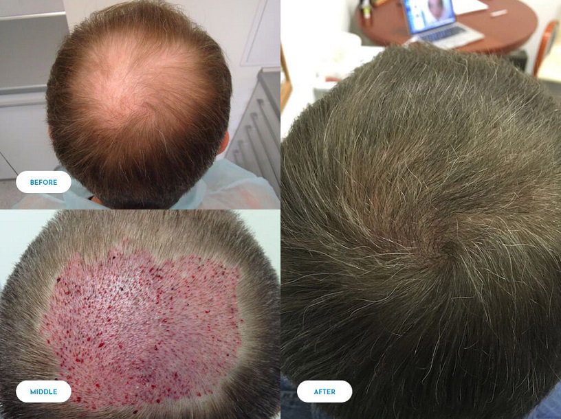 Hair Transplant- Does It Works| Know More