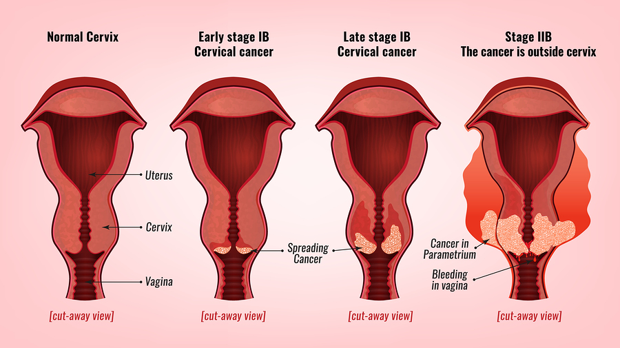 Cervical-Cancer