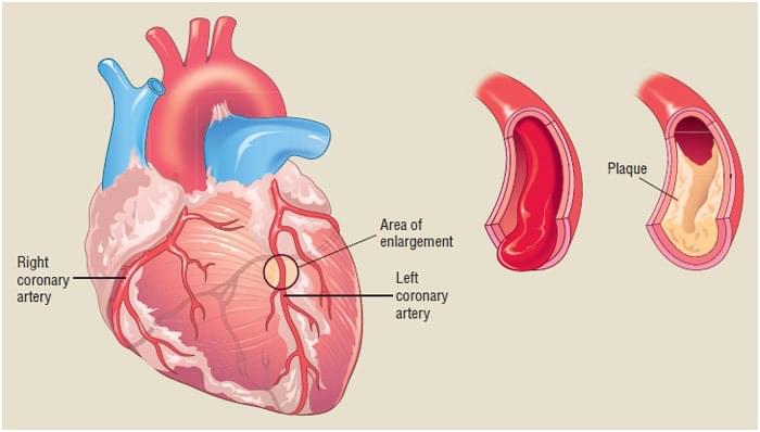 coronary heart disease