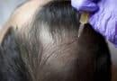 PRP Hair Treatment Cost In India | Process & Side Effects prp-hair-treatment-cost-in-India