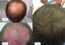 Hair Transplant- Does It Works| Know More hair transplant