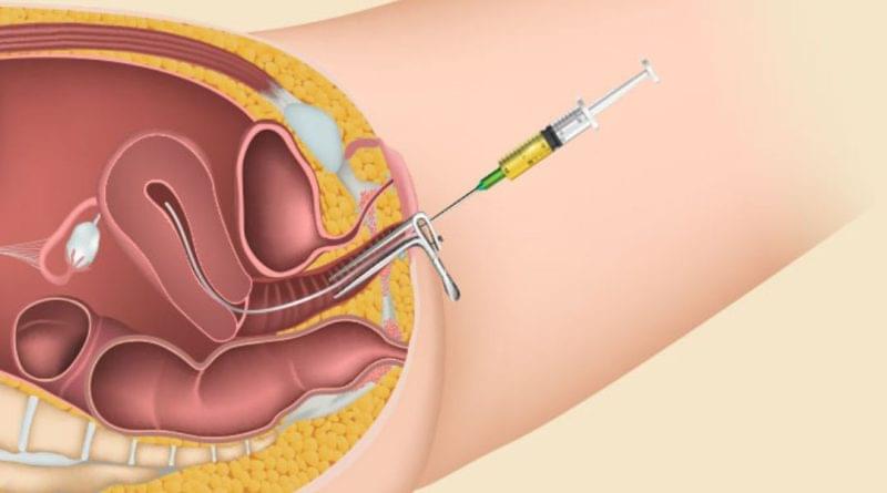 Is IUI Process Painful? is IUI process painful?